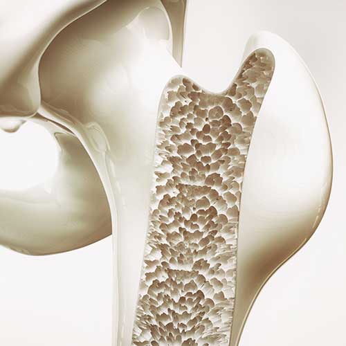 3d rendering of stage 4 Osteoporosis